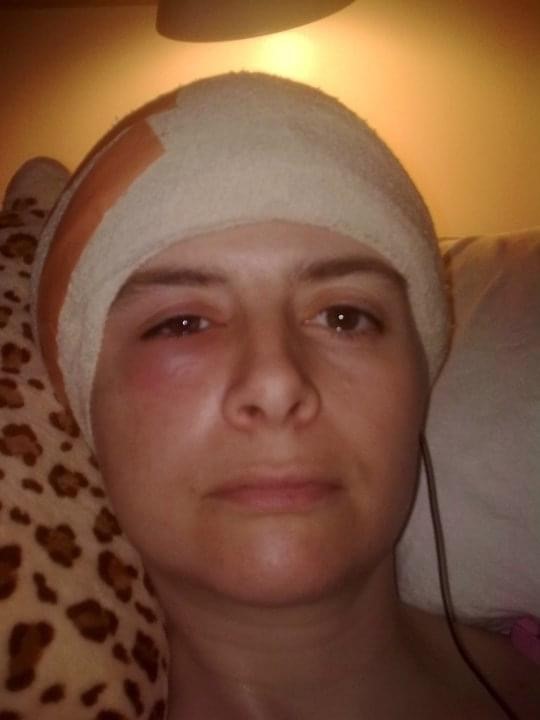 Woman with a bandage on her head and swollen eye after surgery